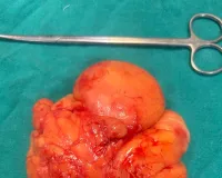 గజ్వేల్ జిల్లా ఆసుపత్రిలో అరుదైన శస్త్రచికిత్స....